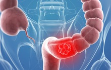 Ung thư đại tràng thường phát hiện muộn: Đột phá nhờ xét nghiệm máu?