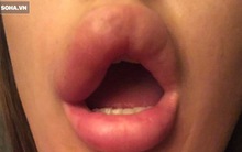 Bơm môi giá "bèo" vì nghe quảng cáo Facebook: Chậm 1 phút vô phương cứu chữa!