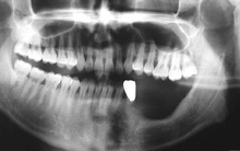 Cảnh báo: Bị đau răng chần chừ không đi khám, đến khi không chịu được thì đã hoại tử hàm