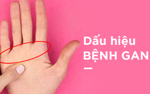 Một điểm trên bàn tay bị đỏ: Dấu hiệu cảnh báo bệnh gan không thể xem nhẹ