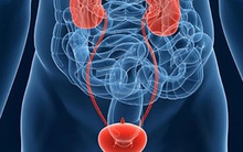 Bác sĩ cảnh báo ung thư bàng quang đã gặp ở người trẻ: Đi tiểu gặp dấu hiệu này phải khám ngay