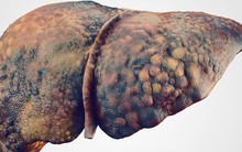 Có dấu hiệu này coi chừng viêm gan nhiễm độc