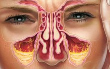 8 cách làm giảm nghẹt mũi tự nhiên mùa này ai cũng nên biết