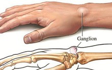 Khi bị nổi cục u không đau, đừng tự 'đoán' lành hay ác, khám chậm trễ có thể thành tật