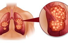5 loại ung thư khó phát hiện sớm nhất hiện nay: Cẩn trọng không bao giờ thừa!