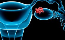 1 triệu chứng không đau báo hiệu tới 3 bệnh ung thư: Nhận ra sớm là yếu tố sống còn