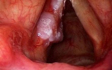 GĐ BV Tai Mũi Họng: Bất kỳ ai có dấu hiệu này 5 - 7 ngày không đỡ phải đi khám ung thư ngay