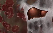 Trong các bệnh ung thư bắt nguồn từ gan, đây là loại phổ biến nhất!