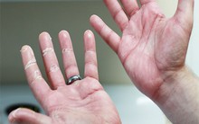 Mất 30 năm, tôi mới tìm được bác sĩ chẩn đoán đúng bệnh tự miễn mà mình gánh chịu