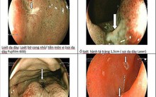 Chuyên gia tiêu hóa chỉ ra thủ phạm chính gây loét dạ dày