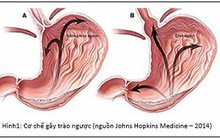 Ba biến chứng của trào ngược thực quản