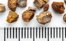 6 triệu chứng bất thường cảnh báo bệnh sỏi thận mà bạn không nên chủ quan bỏ qua