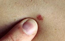 Ung thư từ nốt ruồi rất nguy hiểm, di căn nhanh: Những dấu hiệu của nốt ruồi cần cảnh giác