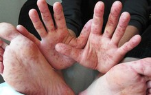 Chuyên gia dịch tễ: Đa số trẻ tử vong vì tay chân miệng do tự điều trị tại nhà