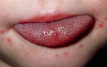 Chuyên gia chỉ cách phân biệt bệnh tay chân miệng với các bệnh khác?
