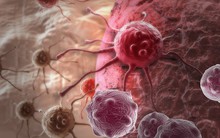 Dù số người tử vong do ung thư tuyến tụy đứng thứ 3 ở Mỹ và đứng thứ 5 ở Anh nhưng "sát nhân thầm lặng" này sẽ không có cơ hội nếu được phát hiện sớm