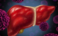 Tỷ lệ mắc ung thư gan ở Việt Nam cao thứ 5 thế giới và đây là cách để phòng chống