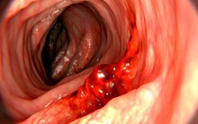 Ung thư dạ dày có tỷ lệ tử vong cao: Làm đủ 4 việc để sớm ngăn chặn mầm bệnh "sinh sôi"