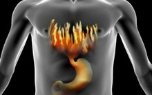 TS Mỹ bật mí 6 cách giảm ợ nóng và trào ngược dạ dày, từ đó ngăn ngừa ung thư