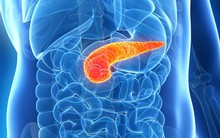 Ung thư tuyến tụy: Khó chuẩn đoán nhưng nguy cơ tử vong cao, đây là những dấu hiệu ban đầu mà bạn thường xem nhẹ