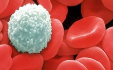 Bác sĩ Viện Huyết học và Truyền máu TƯ chỉ ra 6 dấu hiệu sớm của bệnh ung thư máu