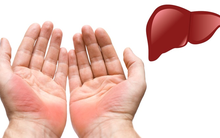 7 dấu hiệu thường gặp trên bàn tay nhưng ẩn chứa nguy cơ sức khỏe nghiêm trọng, đừng chủ quan để phải hối hận