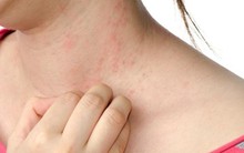 Dị ứng thời tiết vào mùa hè: Bất kể ai cũng có thể gặp phải và những lưu ý từ chuyên gia nhất định không được bỏ qua