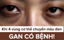 Khi 4 bộ phận cơ thể chuyển màu đen: Hãy thận trọng với dấu hiệu bệnh gan đang phát triển