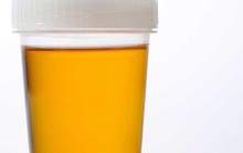 Tự khám bệnh qua màu sắc nước tiểu: Tất cả mọi người nên biết để phòng bệnh hiệu quả