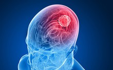 Cẩn thận với những dấu hiệu tố cáo bạn đang có một khối u não