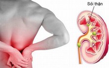 “Mùa sỏi thận” - Làm gì để tránh bệnh?