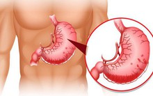 Những thực phẩm có thể "ăn mòn" dạ dày: Người bệnh muốn "giữ" an toàn bao tử thì nên chú ý