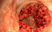 4 triệu người Việt mắc bệnh đại tràng: Thủ phạm có thể là món "ưa thích" trên mâm cơm