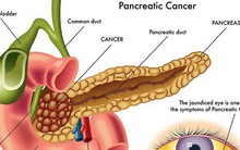 Viêm tuỵ cấp - diễn biến nhanh, cực nguy hiểm: Thể hoại tử chỉ còn 1% cơ hội sống sót