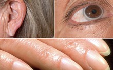 Chỉ cần nhìn dấu hiệu này ở mắt, tai và ngón tay, bạn sẽ biết mình bị bệnh tim