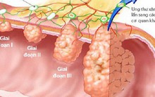 6 yếu tố làm tăng nguy cơ ung thư ruột: Rất nhiều người mắc phải nguyên nhân thứ 6