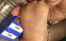 Cảnh báo tay chân miệng, dấu hiệu cha mẹ đừng bỏ qua