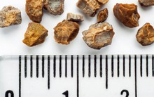 7 cách phòng ngừa sỏi thận hình thành: Thực hiện mỗi ngày, không lo bị bệnh!