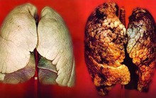 Không hút thuốc lá mà vẫn bị ung thư phổi, chuyên gia xác nhận đây chính là "thủ phạm"