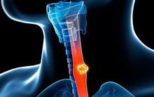 [Cẩm nang] Ung thư thực quản chỉ bắt đầu bằng dấu hiệu khó nuốt, cần cảnh giác khám sớm