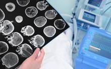 Nếu không muốn mình đột nhiên bị nhồi máu não như người phụ nữ này thì ngay lập tức chấm dứt thói quen xấu mà gần như ai cũng mắc