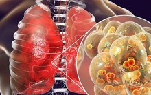 Trời lạnh rất dễ viêm phổi: 8 dấu hiệu "tố cáo" bệnh sớm biết để ngừa biến chứng nguy hiểm