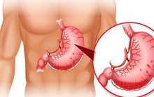 Trước khi dùng thuốc Tây, hãy thử cách của tiến sĩ Mỹ để giảm triệu chứng viêm dạ dày