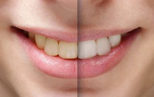 Bị sâu răng và răng ố vàng dù không ăn uống đồ ăn có axit, người đàn ông giật mình khi bác sĩ phát hiện mắc bệnh ung thư dạ dày