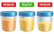 5 dấu hiệu thận của bạn "kêu cứu" vì có sỏi: Đừng để sỏi tăng kích thước sẽ rất phức tạp