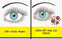 7 triệu chứng dị ứng nhưng chúng ta rất hay nhầm lẫn với bệnh khác nên dễ nguy hiểm nếu không điều trị đúng