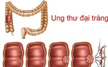 BS khuyến cáo: Uống 1 lon nước ngọt/ngày, ung thư xuất hiện sớm, ác tính hóa nhanh