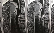 Từ vụ việc cấp cứu bệnh nhân liệt 2 chân ở bệnh viện Việt Đức, bệnh nhân thoát vị đĩa đệm cần lưu ý những gì?