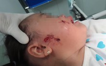 Whitmore - căn bệnh gây ra bởi "vi khuẩn ăn thịt người" tưởng đã bị lãng quên ở Việt Nam nhưng vừa khiến 4 người tử vong thực sự nguy hiểm thế nào?