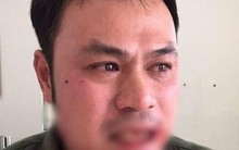 Tạm giữ hình sự người phụ nữ đánh gãy răng nhân viên an ninh Cảng hàng không Nội Bài